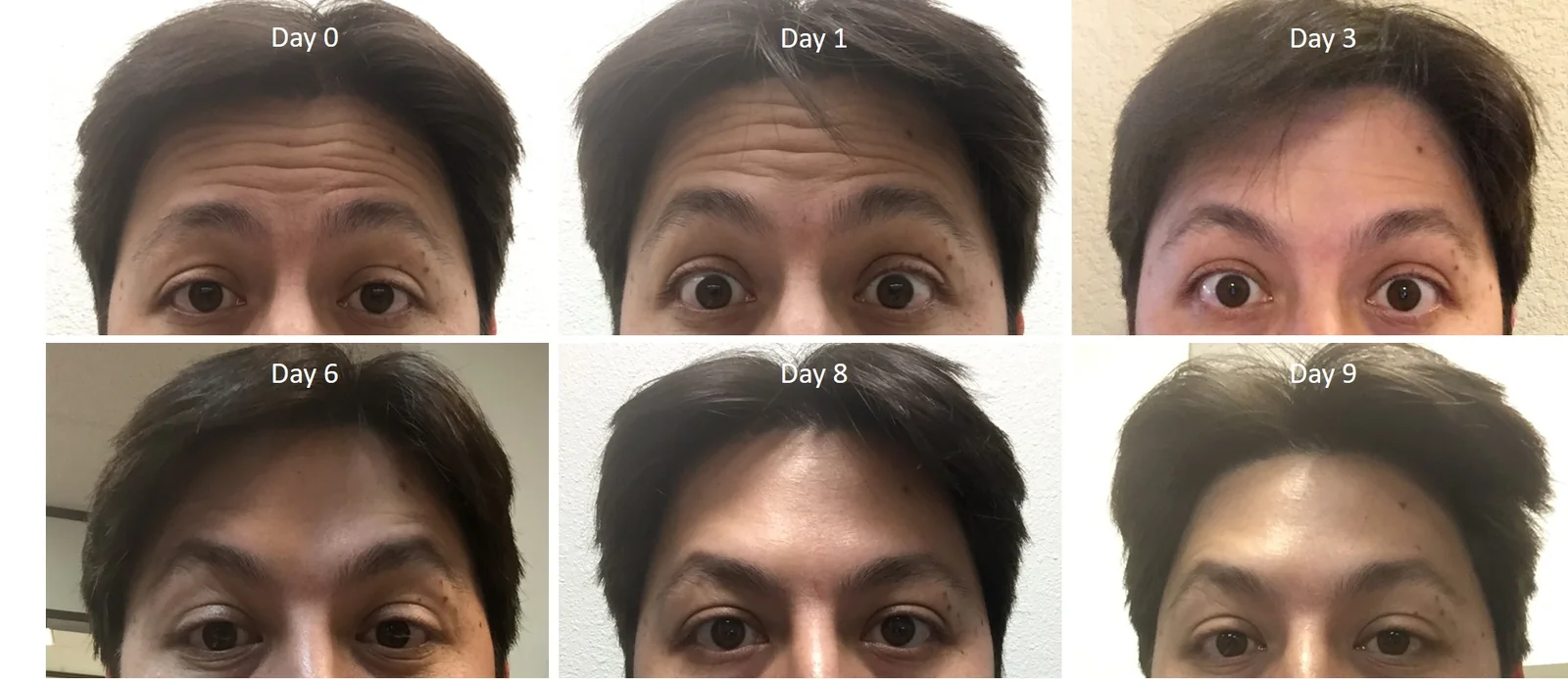 Dr. Levesque's forehead lines smoothing from Day 0 to Day 9 after neuromodulator treatment