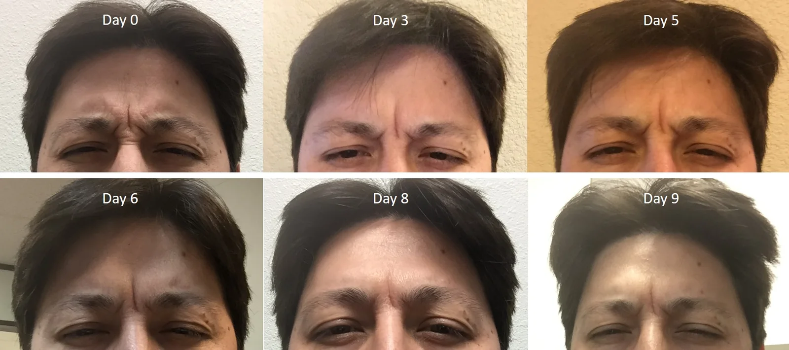 Dr. Levesque's frown lines (between the brows) softening from Day 0 to Day 9 after neuromodulator treatment