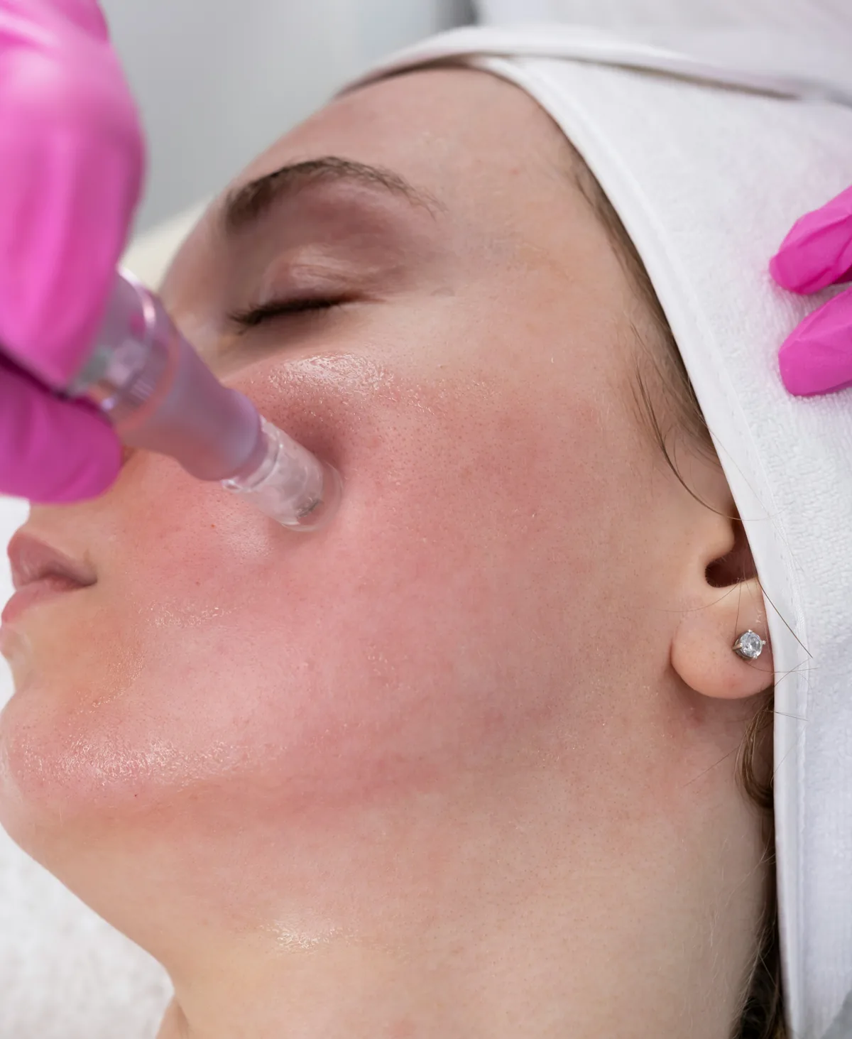 Microneedling facial treatment — Levesque Plastic Surgery, Austin TX