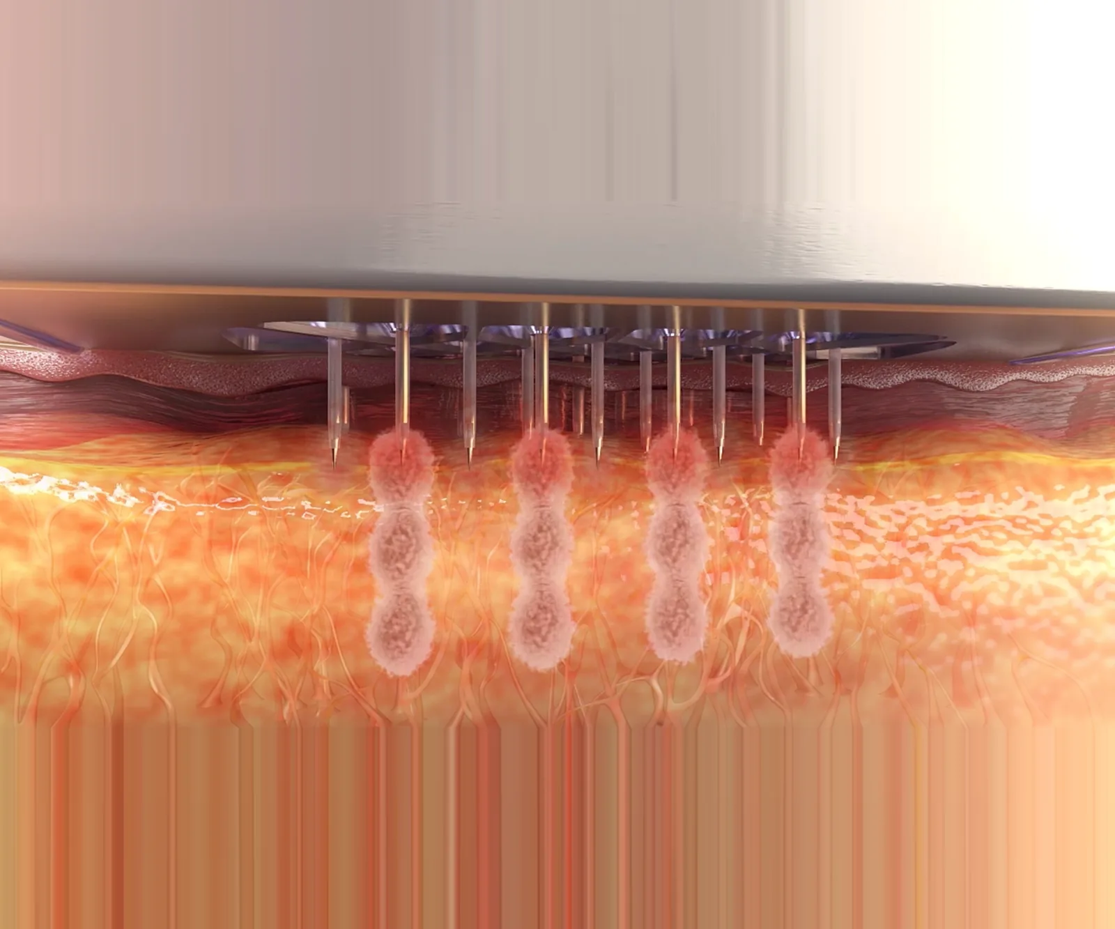 Morpheus8 RF microneedling — Levesque Plastic Surgery, Austin TX