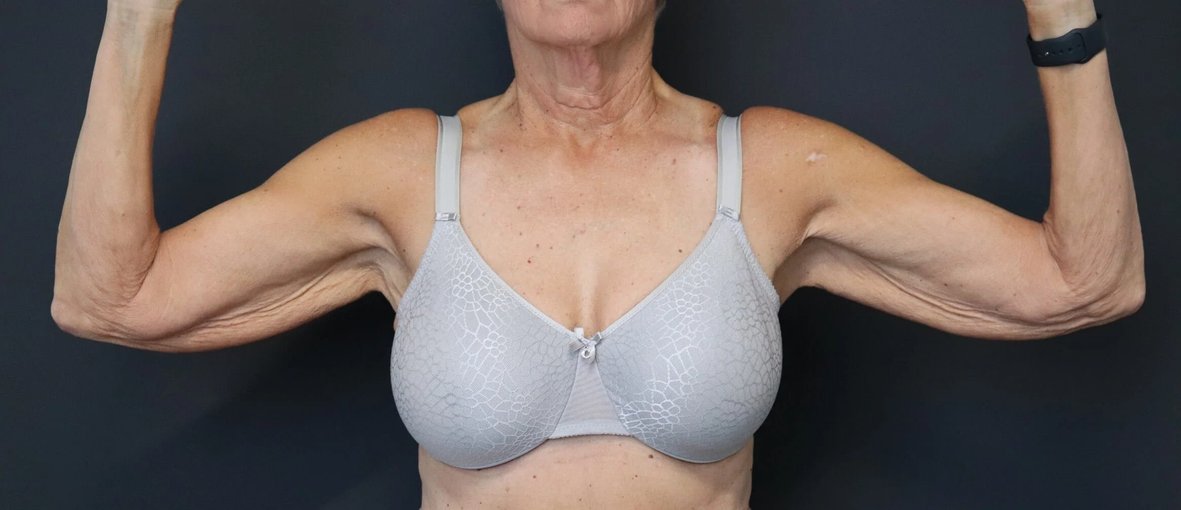 Arm Lift before — case 1, Austin TX