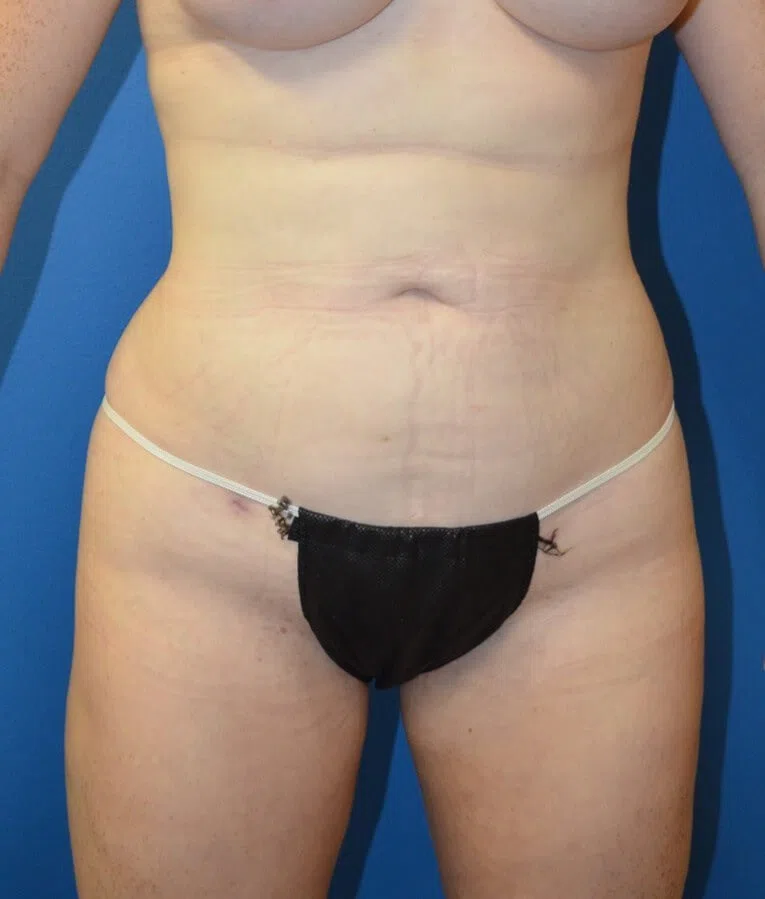 Brazilian Butt Lift after — case 2, Austin TX