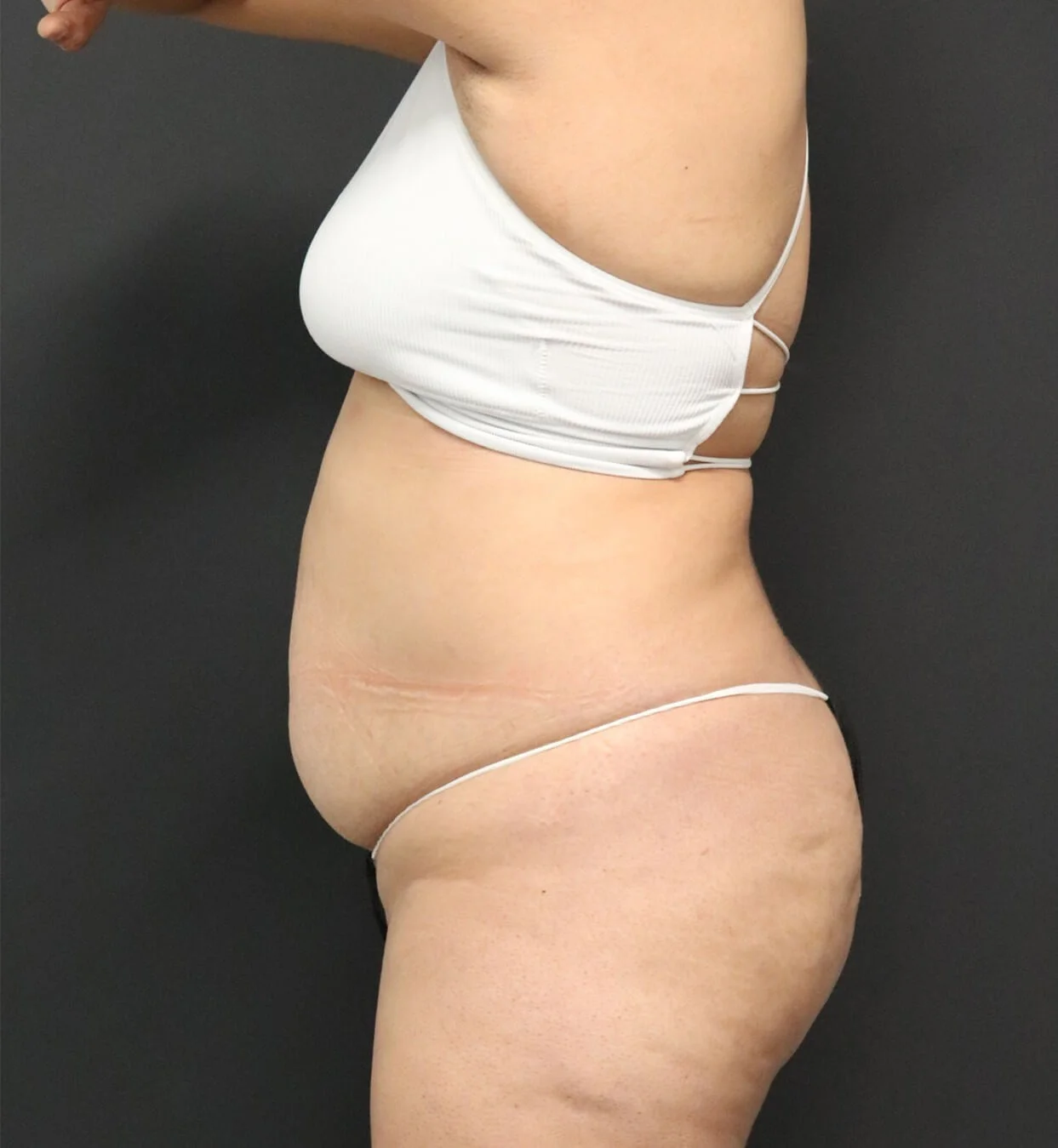 Brazilian Butt Lift before — case 3, Austin TX