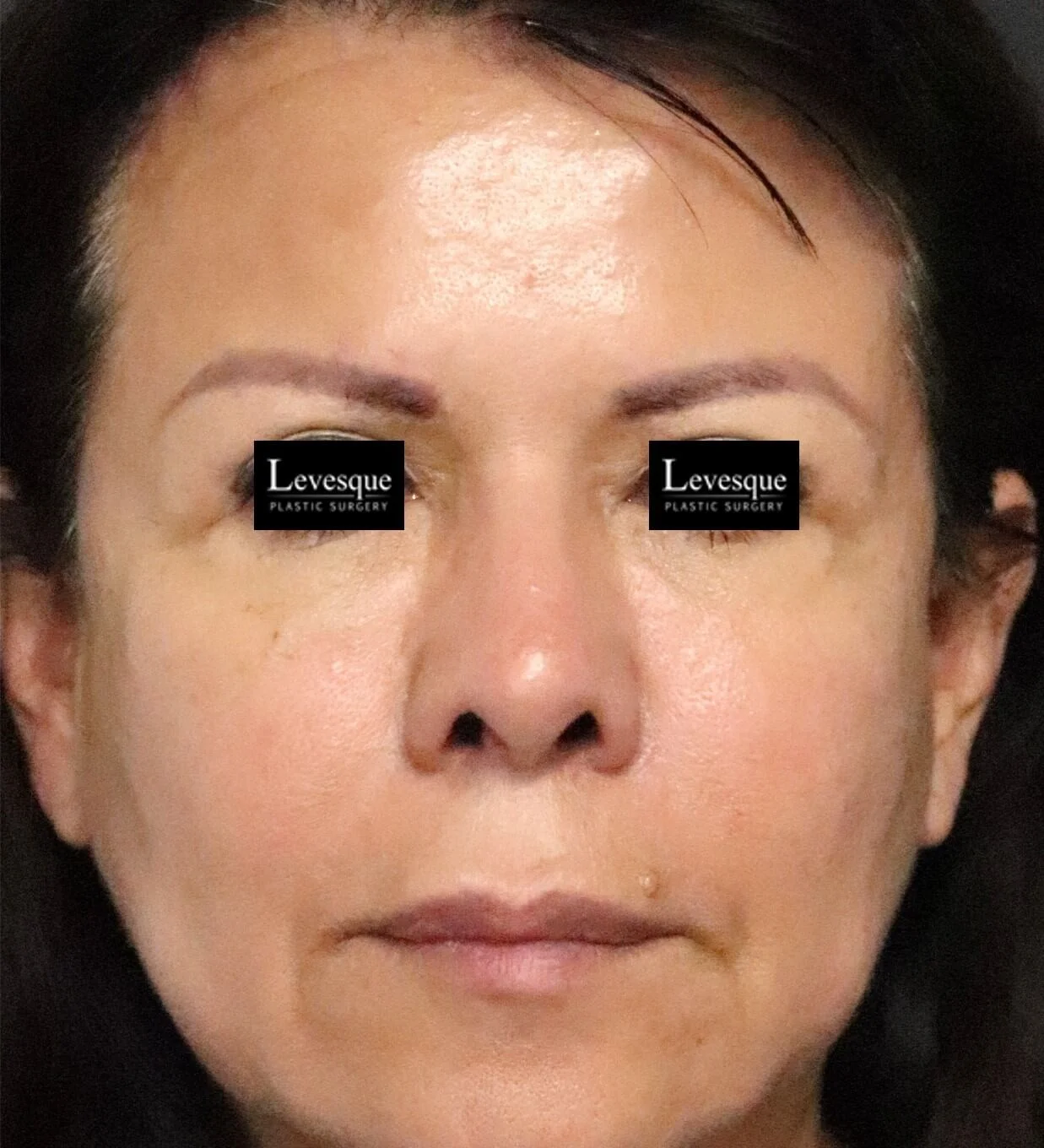 Brow lift Austin TX