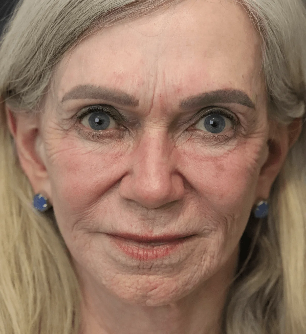 CO2 Laser Resurfacing after — case 1, Austin TX