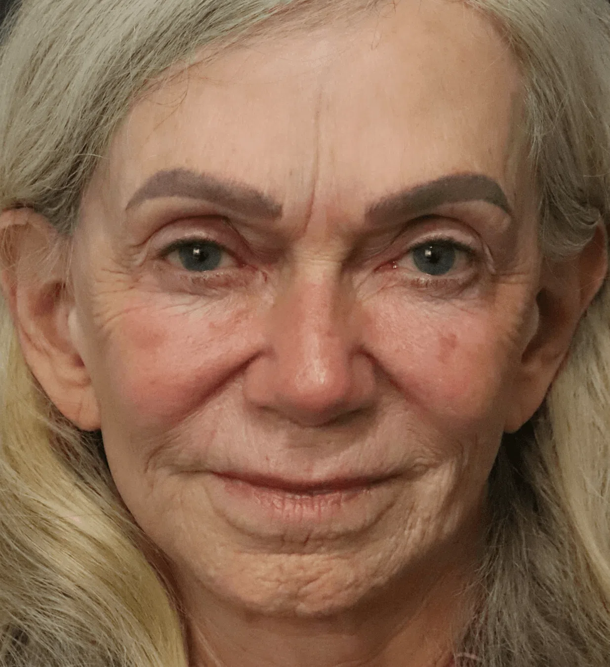 CO2 Laser Resurfacing before — case 1, Austin TX