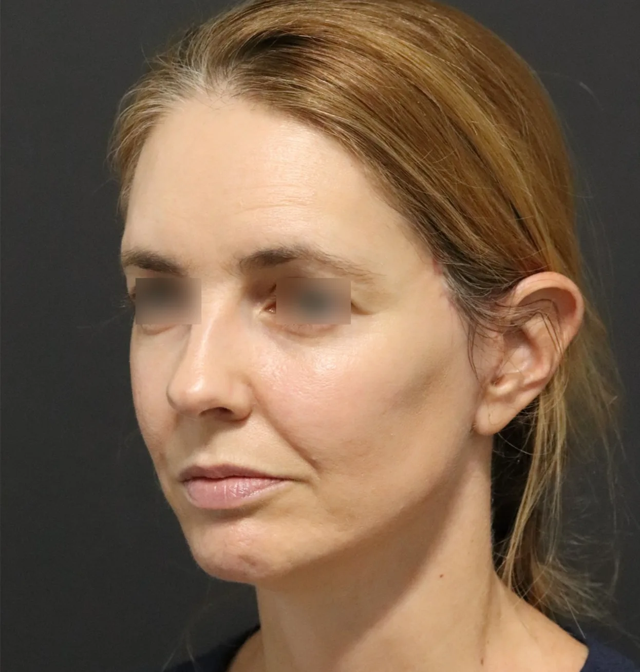 Deep plane facelift after — case 15, Austin TX