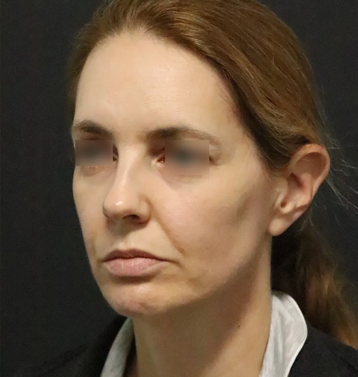 Deep plane facelift before — case 15, Austin TX