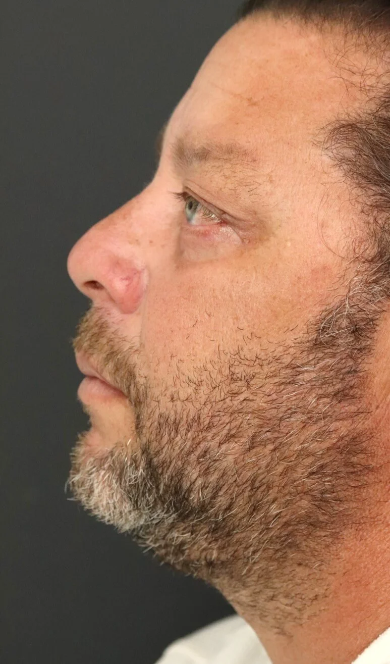 Eyelid lift Austin TX