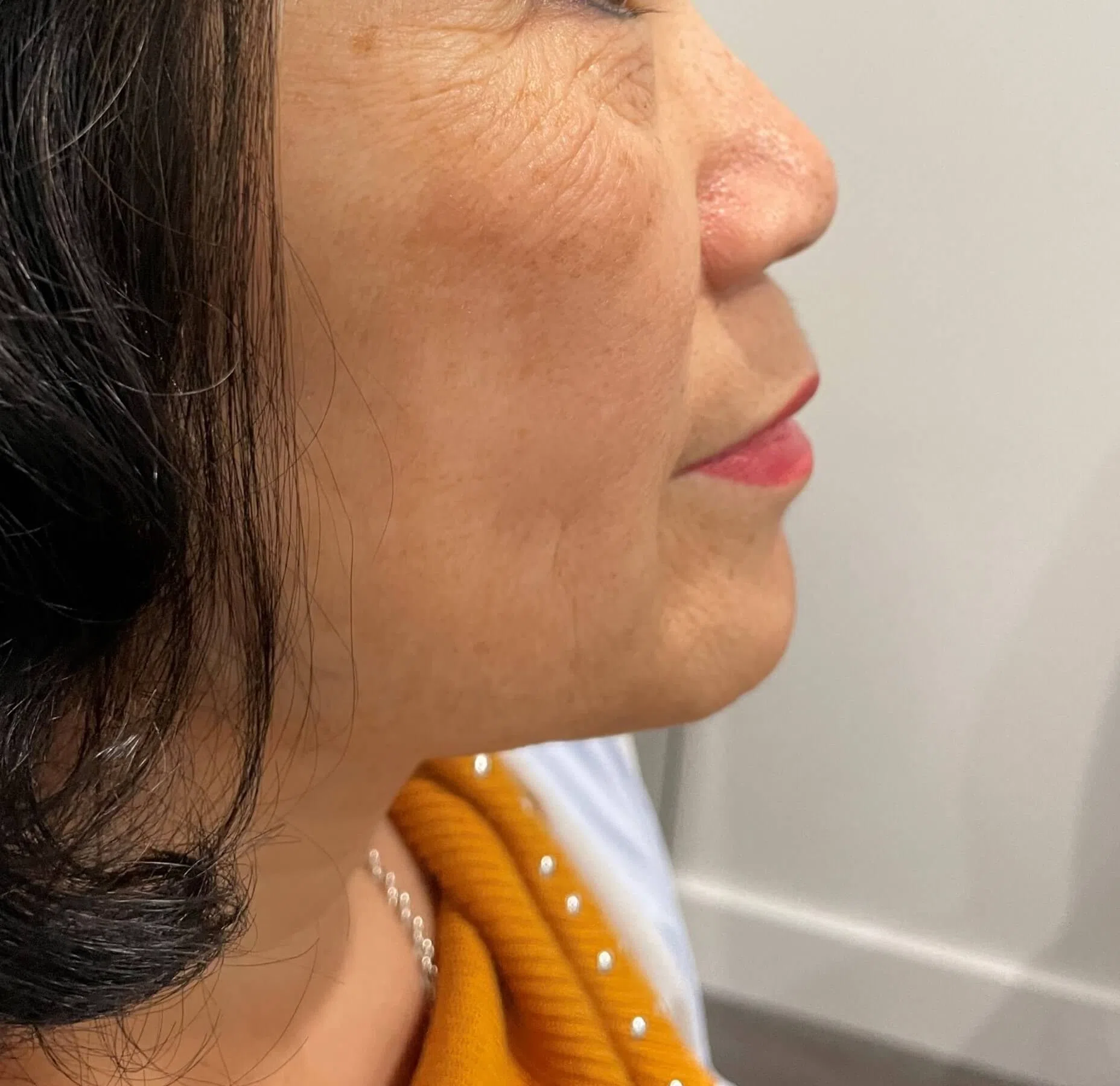 Lumecca IPL after — case 1, Austin TX