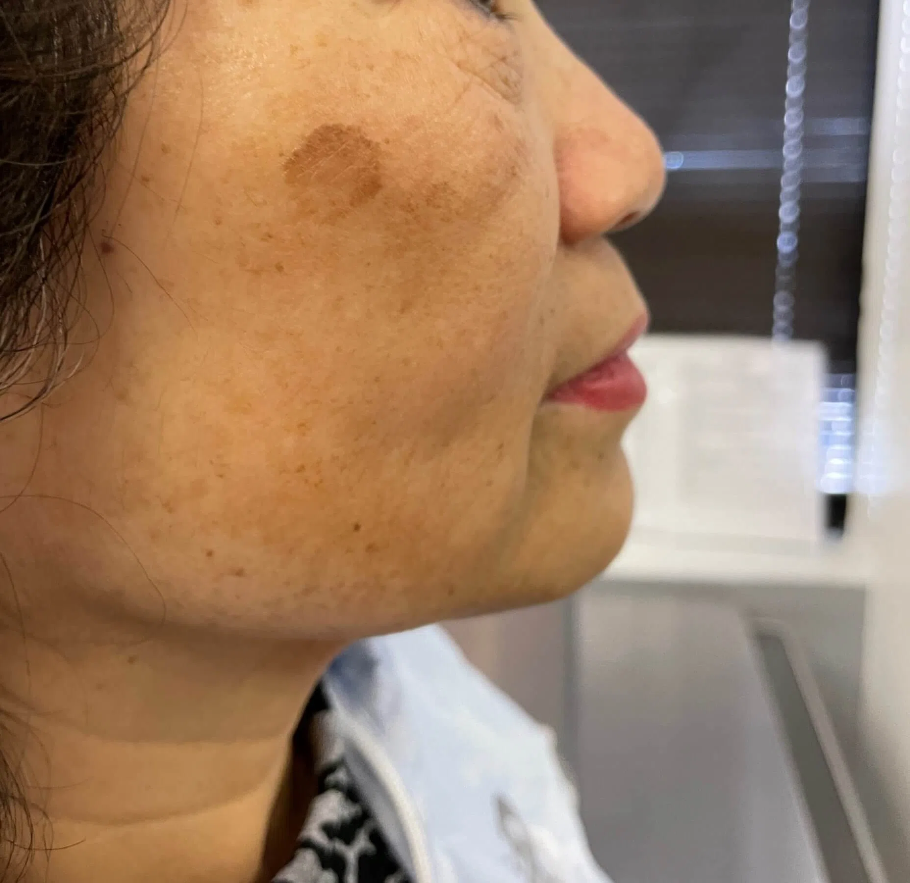 Lumecca IPL before — case 1, Austin TX
