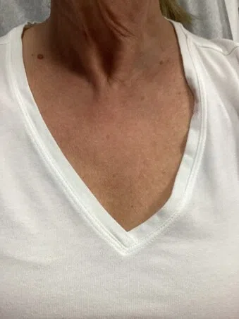 Lumecca IPL after — case 2, Austin TX