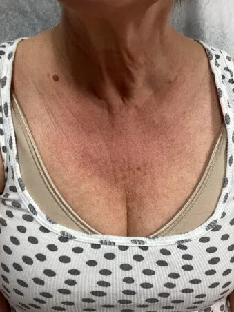 Lumecca IPL before — case 2, Austin TX