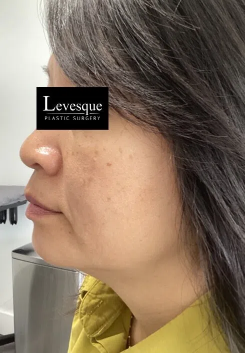 Lumecca IPL after — case 3, Austin TX