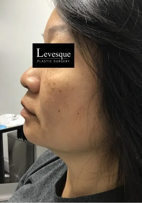 Lumecca IPL before — case 3, Austin TX