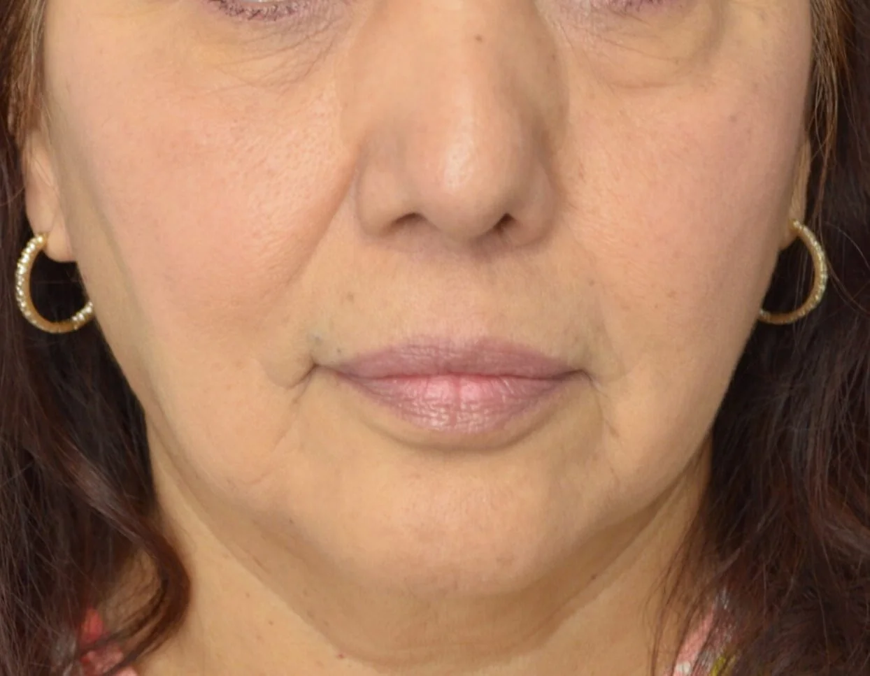 Lip lift Austin TX