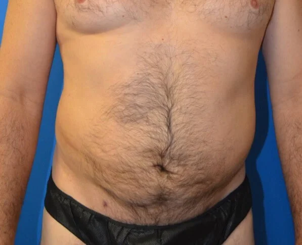 Liposuction Austin TX