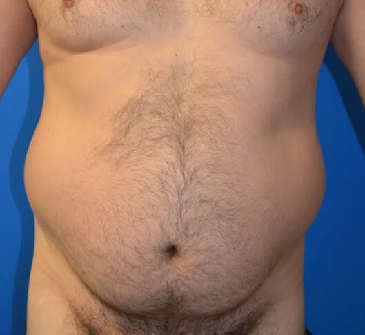 Liposuction before — case 2, Austin TX