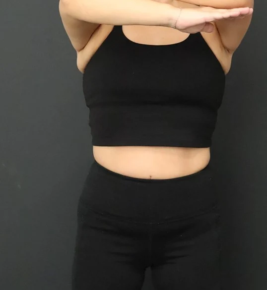 Medical Weight Loss after — case 1, Austin TX