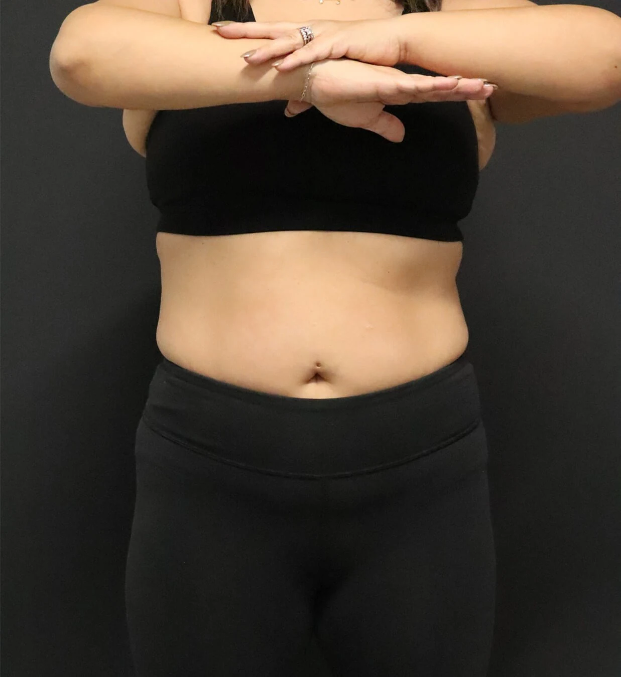 Medical Weight Loss before — case 1, Austin TX